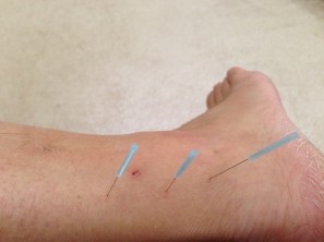 Acupuncture